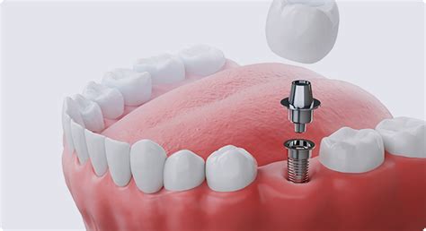 Dental Implants Arvada CO .